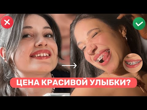 Видео: БРЕКЕТЫ: правда спустя 1,5 года — боль, еда, цена, результат
