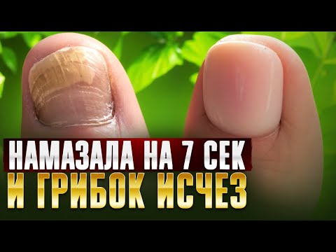 Видео: Как я навсегда уничтожила грибок ногтей! Грибок ногтей на ногах лечение в домашних условиях