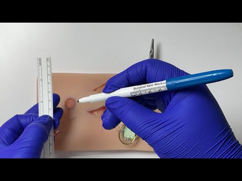 Видео: Следы рака кожи: сделайте ЭТО, чтобы предотвратить неполное удаление