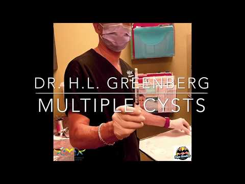 Видео: Дренаж множественных эпидермальных кист-включений от доктора Вегаса - доктора Х.Л. Гринберга, Las...