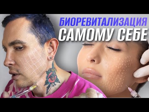 Видео: БИОРЕВИТАЛИЗАЦИЯ самому себе | Как я делаю себе инъекции #самсебекосметолог #биоревитализация