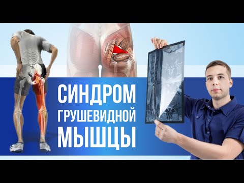 Видео: ГРУШЕВИДНАЯ МЫШЦА (синдром) - самое полное видео на Ютуб. Лечение, упражнения, блокада