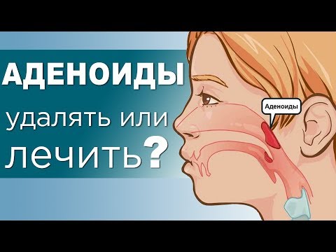Видео: АДЕНОИДЫ у детей. Степени, осложнения и лечение