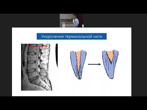 Видео: Фиксированный спинной мозг — диагностика и методы лечения!