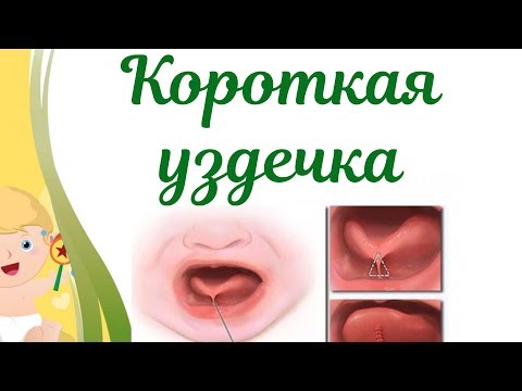 Видео: Короткая уздечка под языком у ребенка! Как определить и помочь?