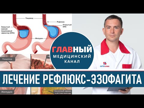 Видео: Лечение Рефлюкс-Эзофагита. Гастроэзофагеальная рефлюксная болезнь. Гастроэзофагеальный рефлюкс