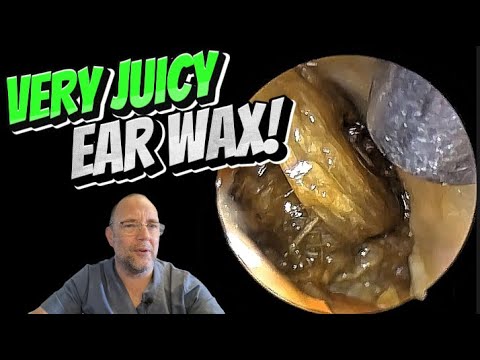 Видео: ОЧЕНЬ СОЧНАЯ УШНАЯ СЕРА! 290 #ухо #ушнаясера #удалениеушнойсеры #чисткаушей #fyp #asmr #длявас #у...