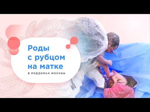Видео: Роды с рубцом на матке бесплатно по полису ОМС в роддомах Москвы