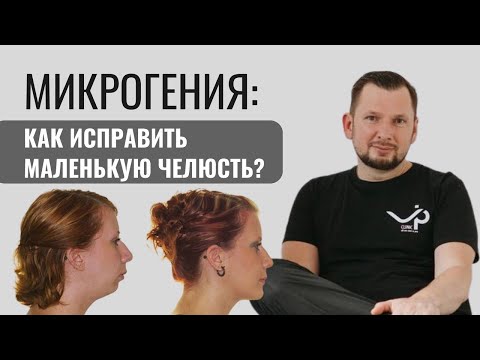Видео: Микрогения. Как исправить маленькую челюсть?