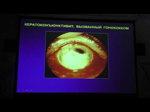 Видео: «Бактериальные кератоконъюнктивиты. Клиника, диагностика, лечение.» Майчук Д.Ю.
