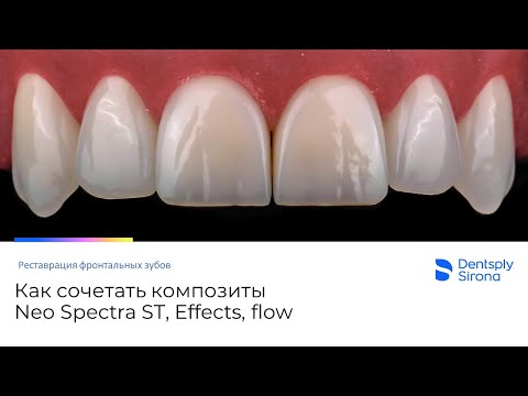 Видео: Как сочетать композиты Neo Spectra ST при реставрации по IV классу