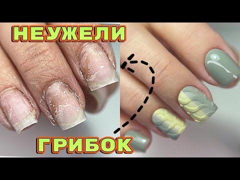 Видео: Пожелтели ногти 😐 Неужели грибок? Вязаный дизайн ногтей 💅Маникюр