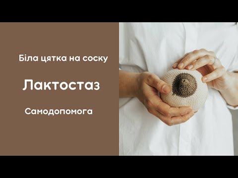 Видео: Лактостаз. Застій молока. Закупорка молочних проток. Біла цятка на соску. Блеб. Самодопомога.