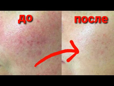 Видео: By Wishtrend PURE VITAMIN C 21.5% ADVANCED SERUM Отзывы | Лучшая сыворотка для лица с витамином С