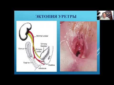 Видео: Нейрогенные дисфункции мочевого пузыря. Алгоритм диагностики и лечения. Энурез. Морозов С. Л.​