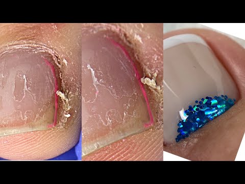 Видео: Что делать? Опять мозоль💅Педикюр на себе💅Френч😍