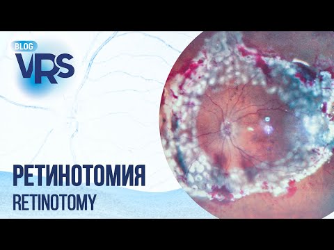 Видео: Ретинотомия | Retinotomy