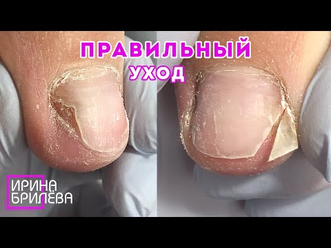 Видео: ПЕДИКЮР 👍 Обработка пальцев ног с ОНИХОЛИЗИСОМ 🌸 Правильный уход за ногтями