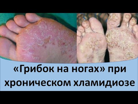 Видео: Грибок на ногах при хроническом хламидиозе