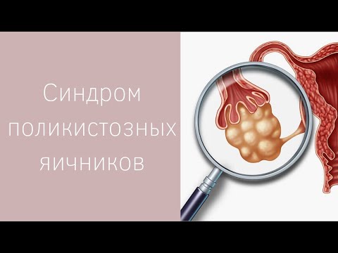 Видео: СИНДРОМ ПОЛИКИСТОЗНЫХ ЯИЧНИКОВ | Как лечить? Как забеременеть?