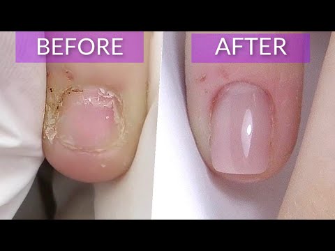 Видео: Короткие обгрызенные ногти: трансформация в квадратную форму