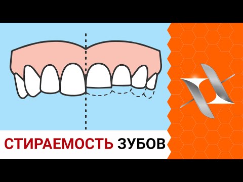 Видео: СТИРАЕМОСТЬ и СКОЛЫ ЗУБОВ | Причины. Последствия. Лечение.