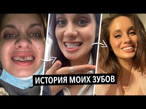 Видео: МОЯ ИСТОРИЯ ЗУБОВ | ВИНИРЫ, БРЕКЕТЫ, КОРОНКИ, УДАЛЕНИЕ