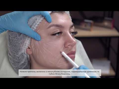 Видео: Ліфтинговий філер на основі гідроксиапатиту кальцію