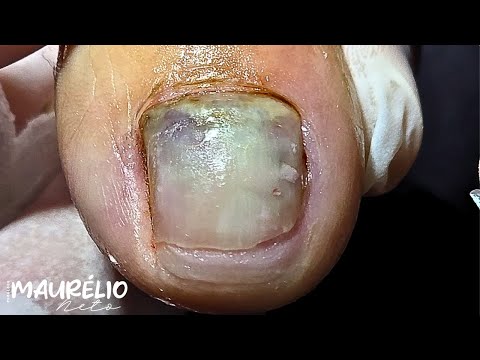 Видео: ЗНАЕТЕ ЛИ ВЫ, ЧТО ДЕЛАТЬ, КОГДА СНИМАЕТСЯ НОГТЬ?