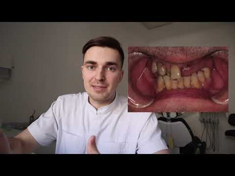 Видео: НЕТ ЗУБОВ! Что делать? #зубныепротезы #стоматология