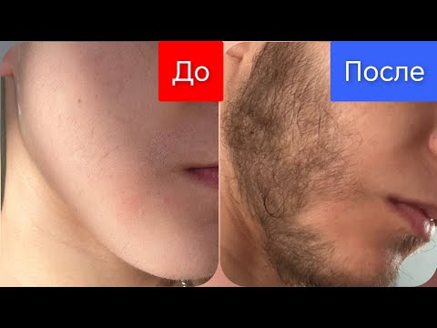 Видео: Минокс личный опыт использования. Андрей Борода средство для роста бороды и волос выпуск 83 
