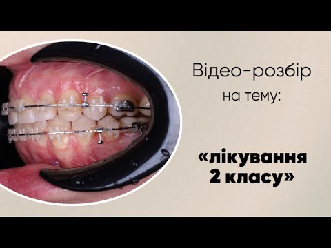 Видео: Лікування 2 класу | Ортодонт Б. Свінціцький