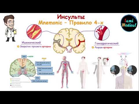 Видео: Диагностика инсультов в зависимости от локализации поражения в мозге| Правило 4-ёх| Легко и просто|