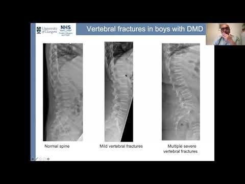 Видео: Конференция по лечению Дюшенна: Управление здоровьем костей, доктор Джарод Вонг