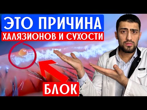 Видео: Самый лучший способ от халязионов, ячменей и сухости в глазах. Массаж век от офтальмолога.