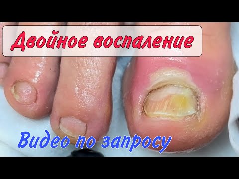 Видео: Болит палец / воспаление на пальце / паронихия / подногтевой панариций