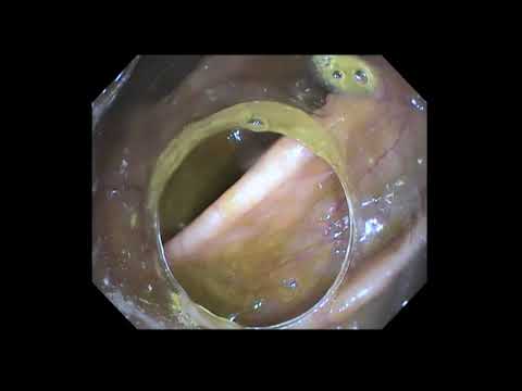 Видео: Неоднозначное воспаление. Полипэктомия в нижнеампулярном отделе прямой кишки.