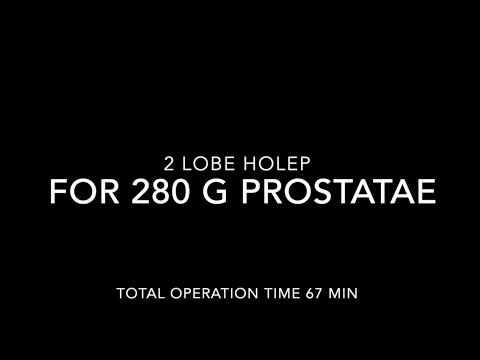 Видео: 2 Lobe HoLEP 280 g/Энуклеация простаты 260 г лазером/2 долевая техника