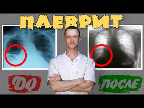 Видео: Плеврит