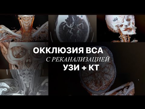 Видео: Окклюзия ВСА с реканализацией. УЗИ и КТ.
