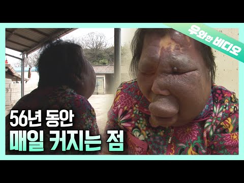 Видео: Женщина, которая прожила без лица 56 лет