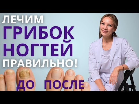 Видео: Грибок ногтей? Забудь! Обновленное видео: Полное руководство по лечению онихомикоза от дерматолога!