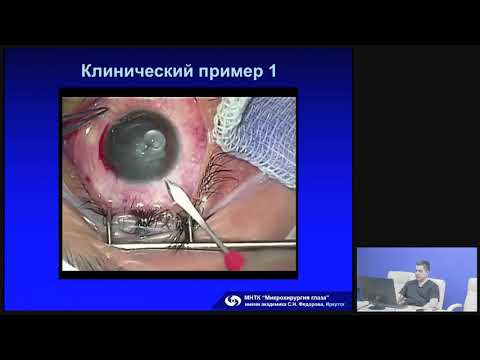Видео: Травма глаза. Клинический случай. Зайка В.А. врач-офтальмолог 2го офт. отд., к.м.н.