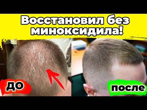 Видео: ОСТАНОВИЛ ВЫПАДЕНИЕ ВОЛОС, Начало применения лосьона Tricapil / Трикапил для роста волос