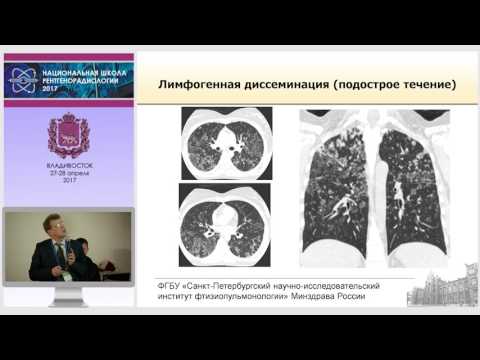 Видео: П.В. Гаврилов - Диссеминированный туберкулез легких: скиалогическая картина