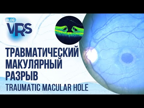Видео: Травматический макулярный разрыв сетчатки. Стоит ли ждать? | Traumatic macular hole.