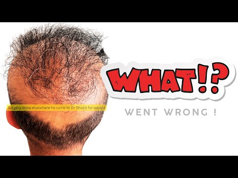 Видео: Пересадка волос в Индии | Почему пересадка волос НЕ УСПЕШНА!