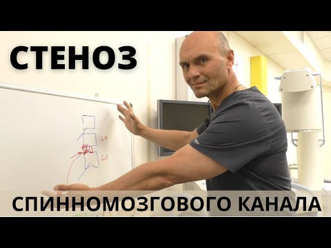 Видео: СТЕНОЗ СПИННОМОЗГОВОГО КАНАЛА ПОЗВОНОЧНИКА: тревожные симптомы и лечение