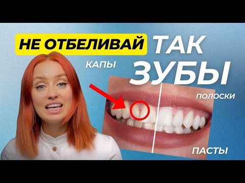 Видео: Как отбелить зубы без вреда? Домашнее отбеливание зубов