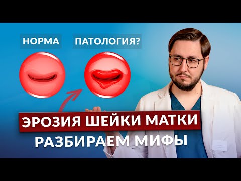 Видео: Вся правда про эрозию шейки матки. Это должна знать каждая женщина